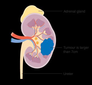Understanding Kidney Tumours.jpg